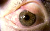 Olho de paciente com conjuntivite